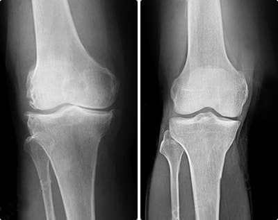 Radiografía comparativa de rodilla — articulación con desgaste vs cartílago restaurado tras curso de Arthrox Plus