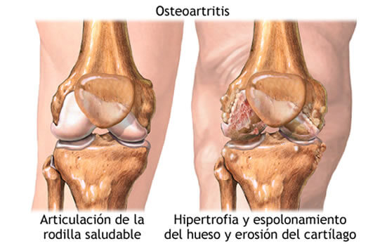 Comparación articulación de rodilla saludable vs. osteoartritis con erosión del cartílago — Joinflex apoya la recuperación articular